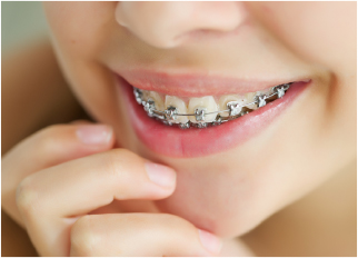 矯正装置の種類 | 奈良で矯正するなら 岡下矯正歯科