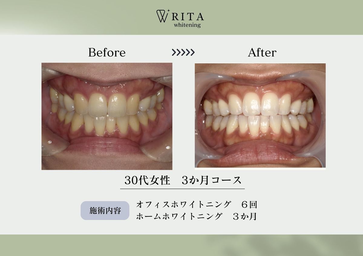 ホワイトニング RITA - 歯科ミントクリニック（富山県滑川市）