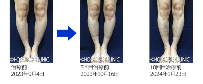 O脚・X脚治療プログラム-痛みの原因治療専門外来【細野クリニック