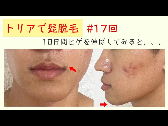 トリアで17回髭脱毛した後の結果が衝撃でした・・・。 - YouTube